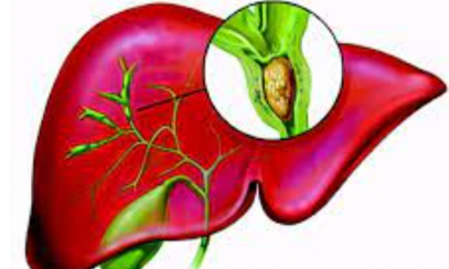 《Journal of Hepatology》中山大学揭示EB病毒相关肝内胆管癌的临床特征