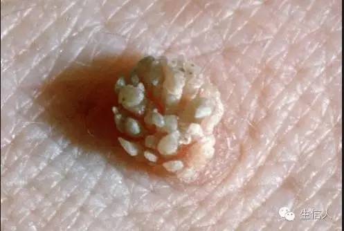 宫颈癌疫苗为啥10多年后才进中国